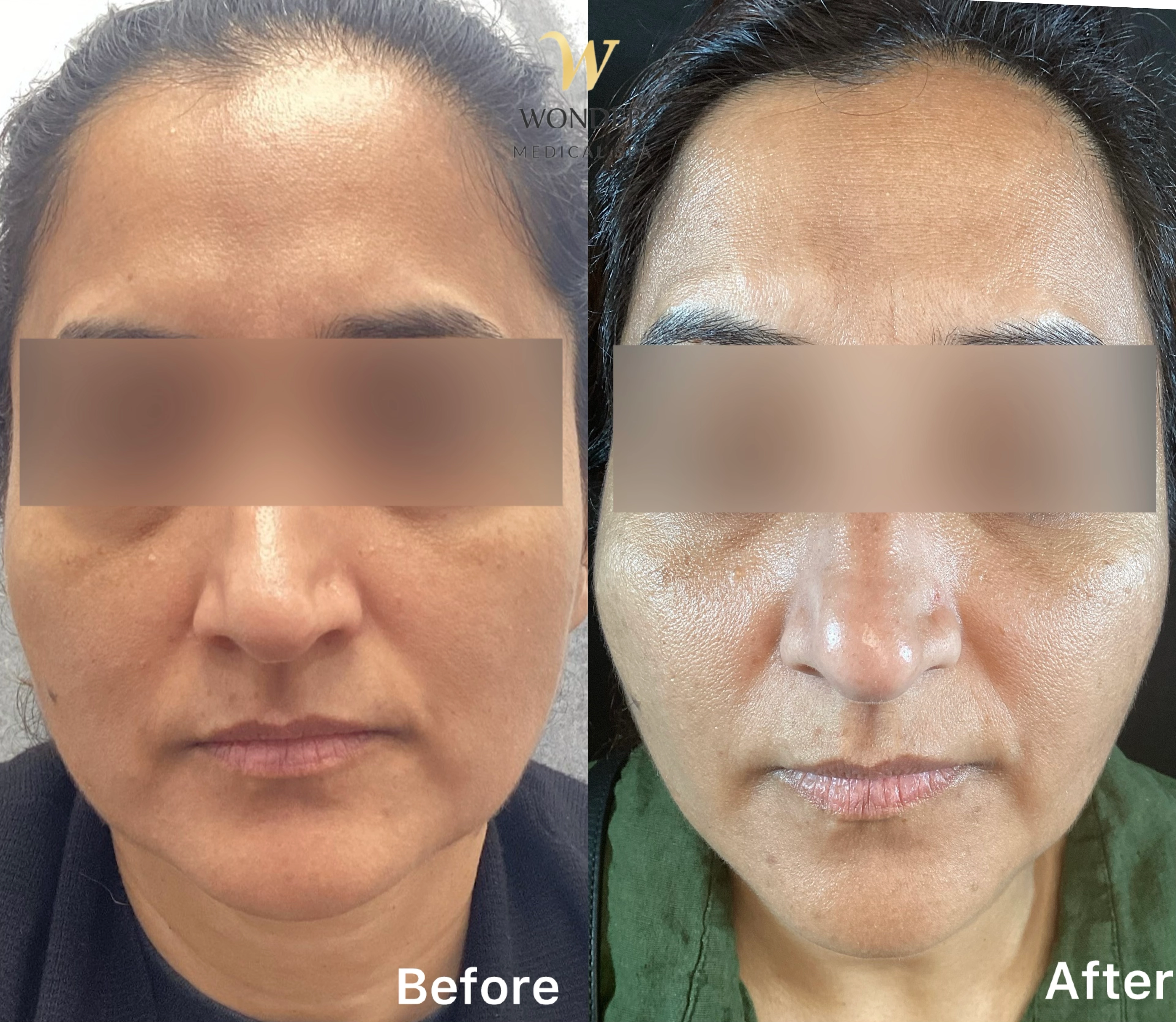 Sculptra Face 1 Result