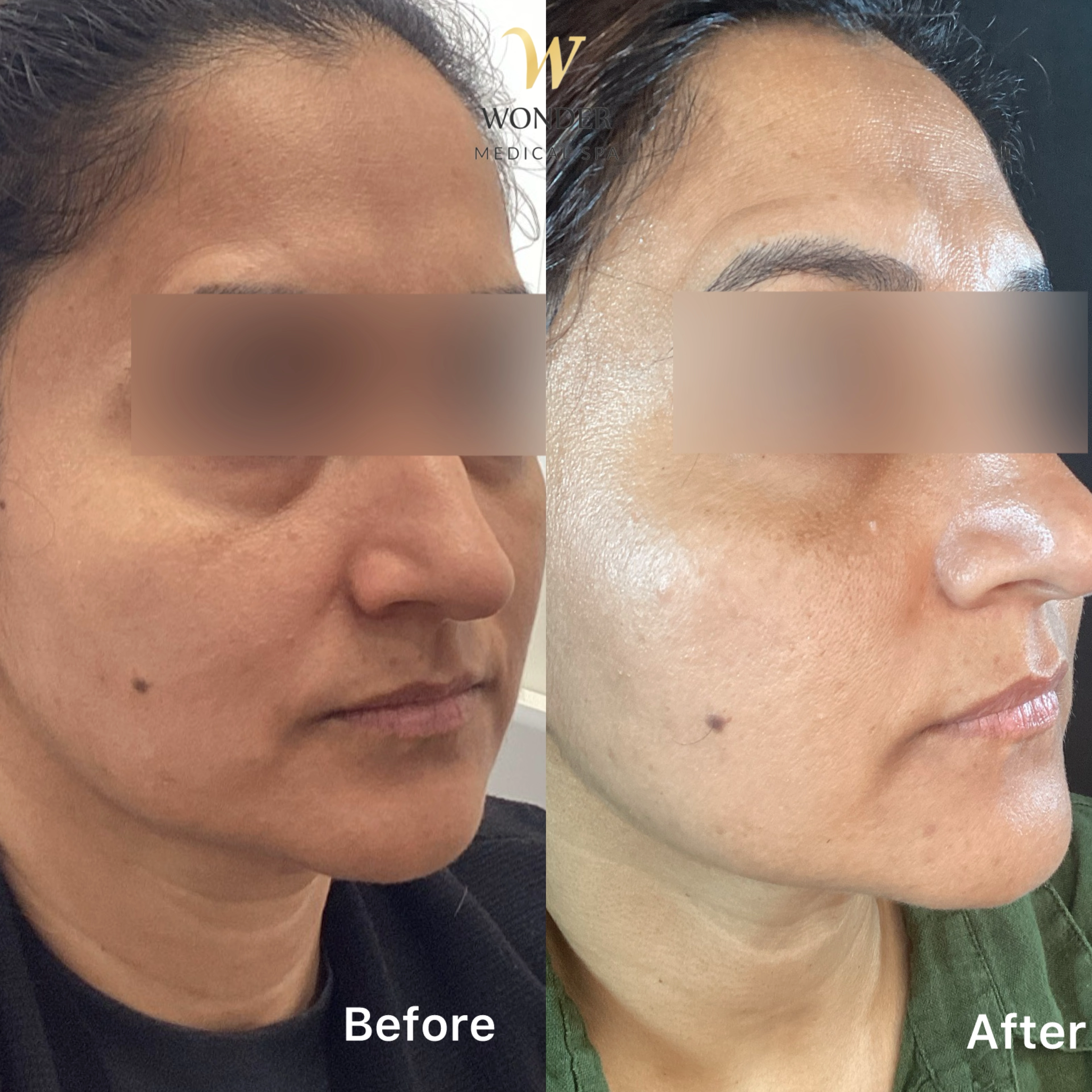 Sculptra Face 2 Result