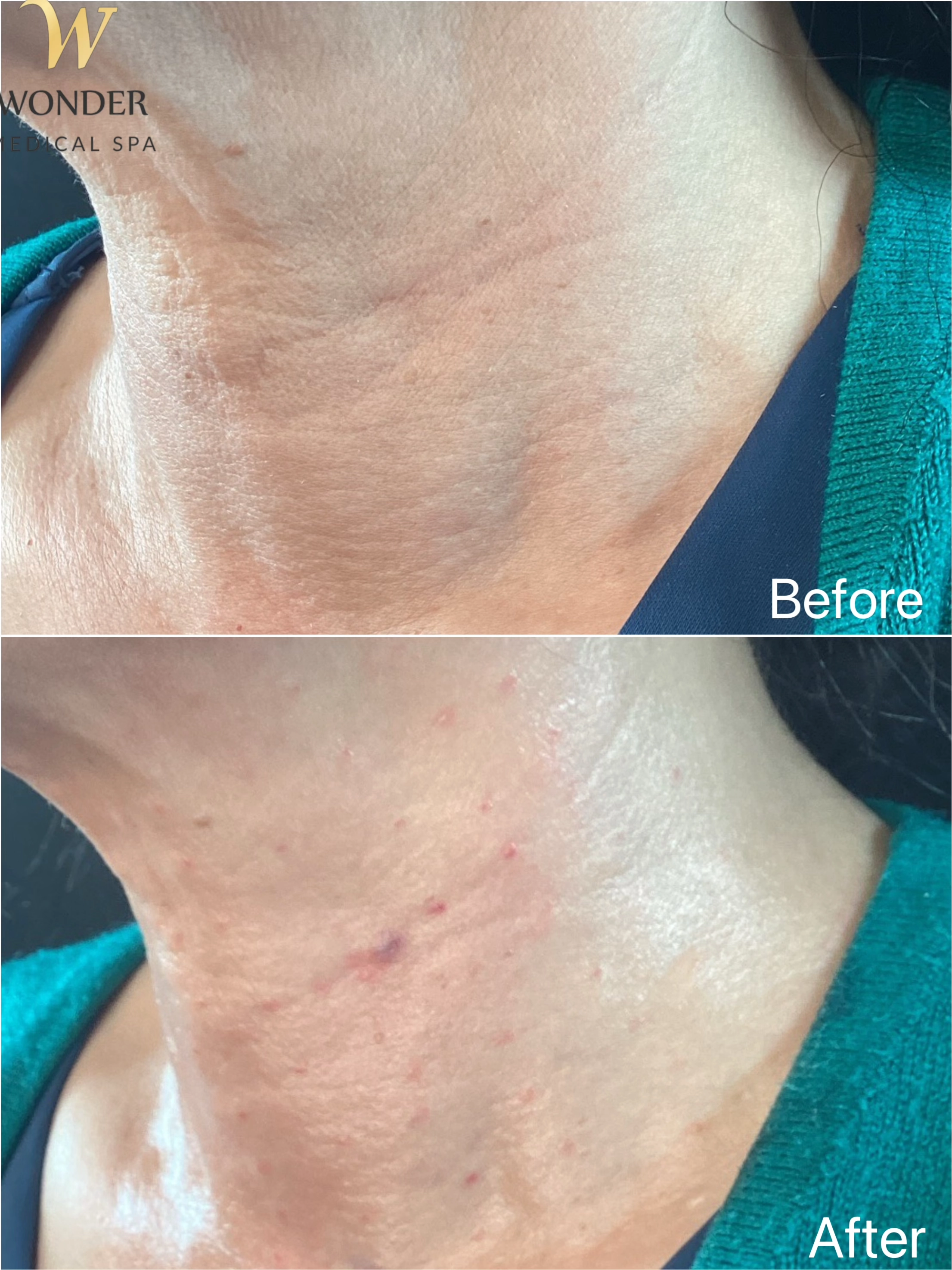 Sculptra Neck 0 Result