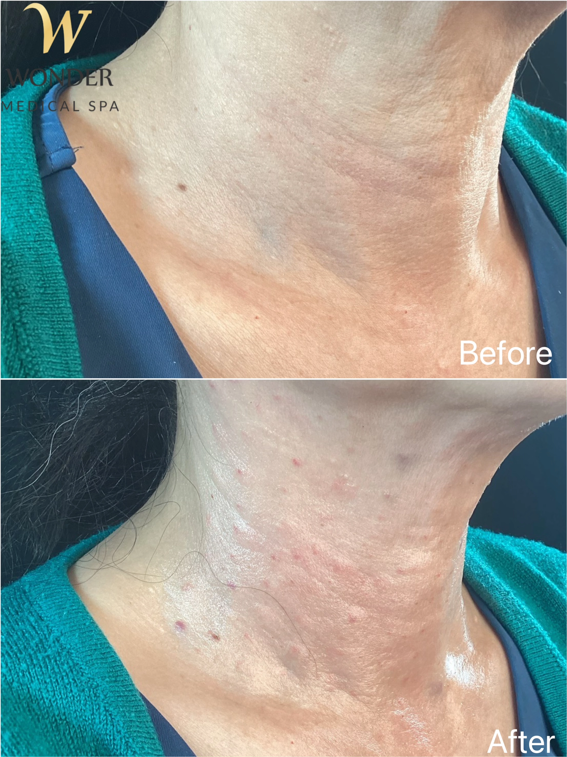 Sculptra Neck 1 Result