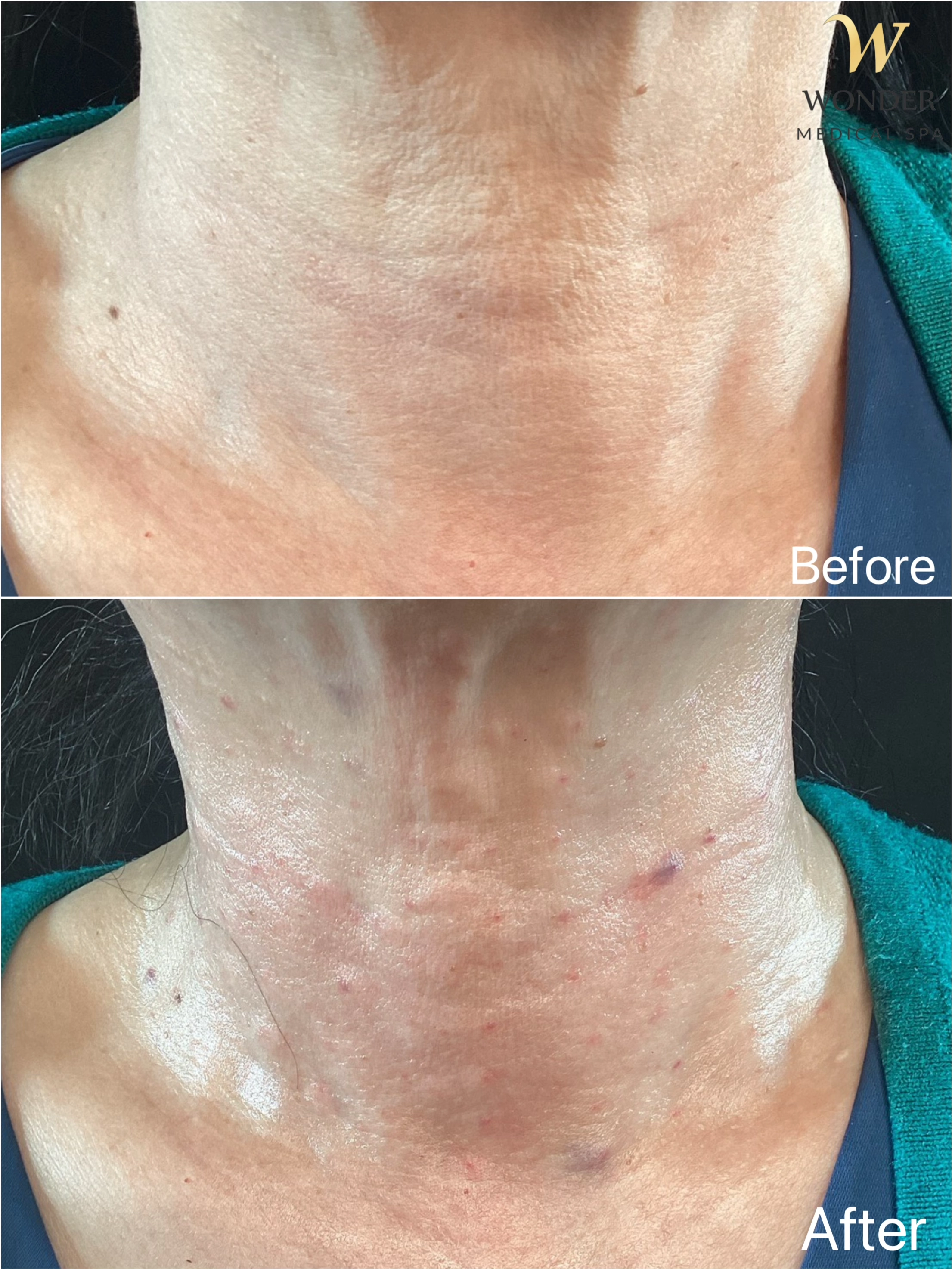 Sculptra Neck 2 Result