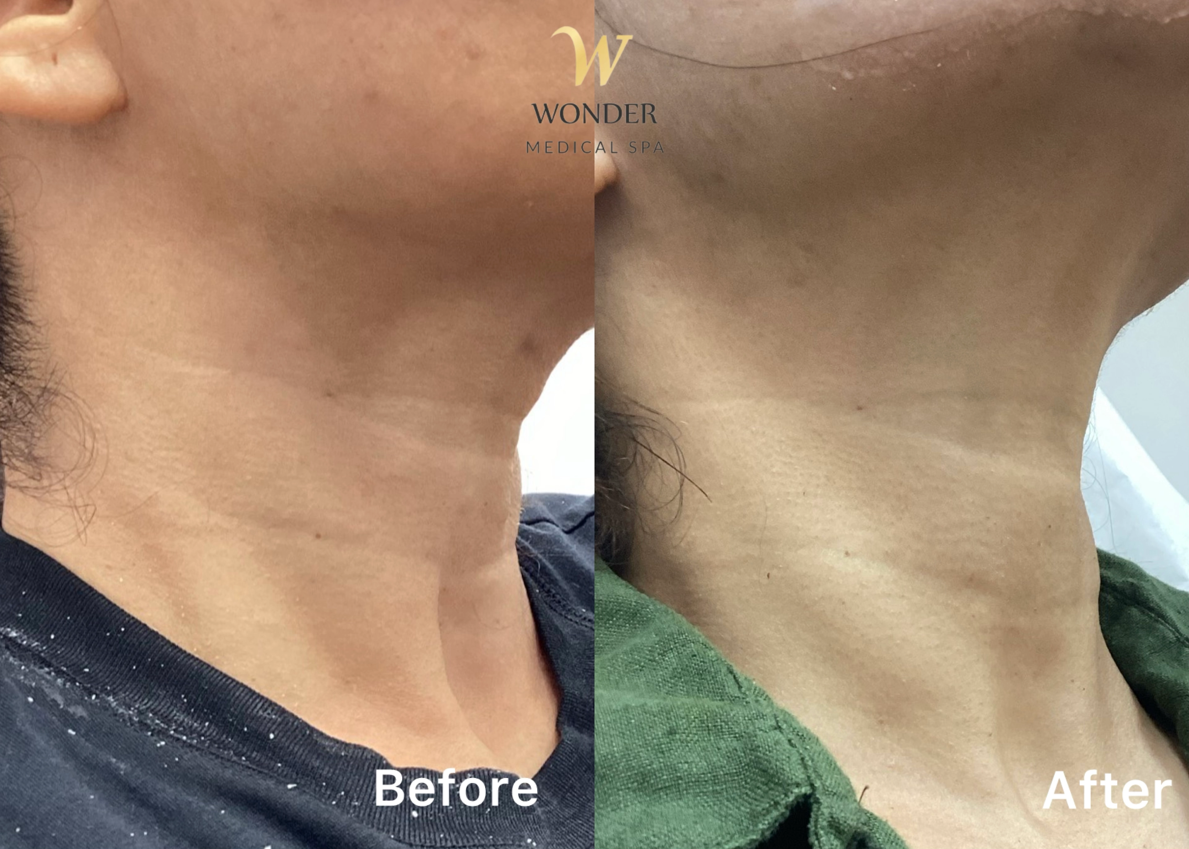 Sculptra Neck 3 Result