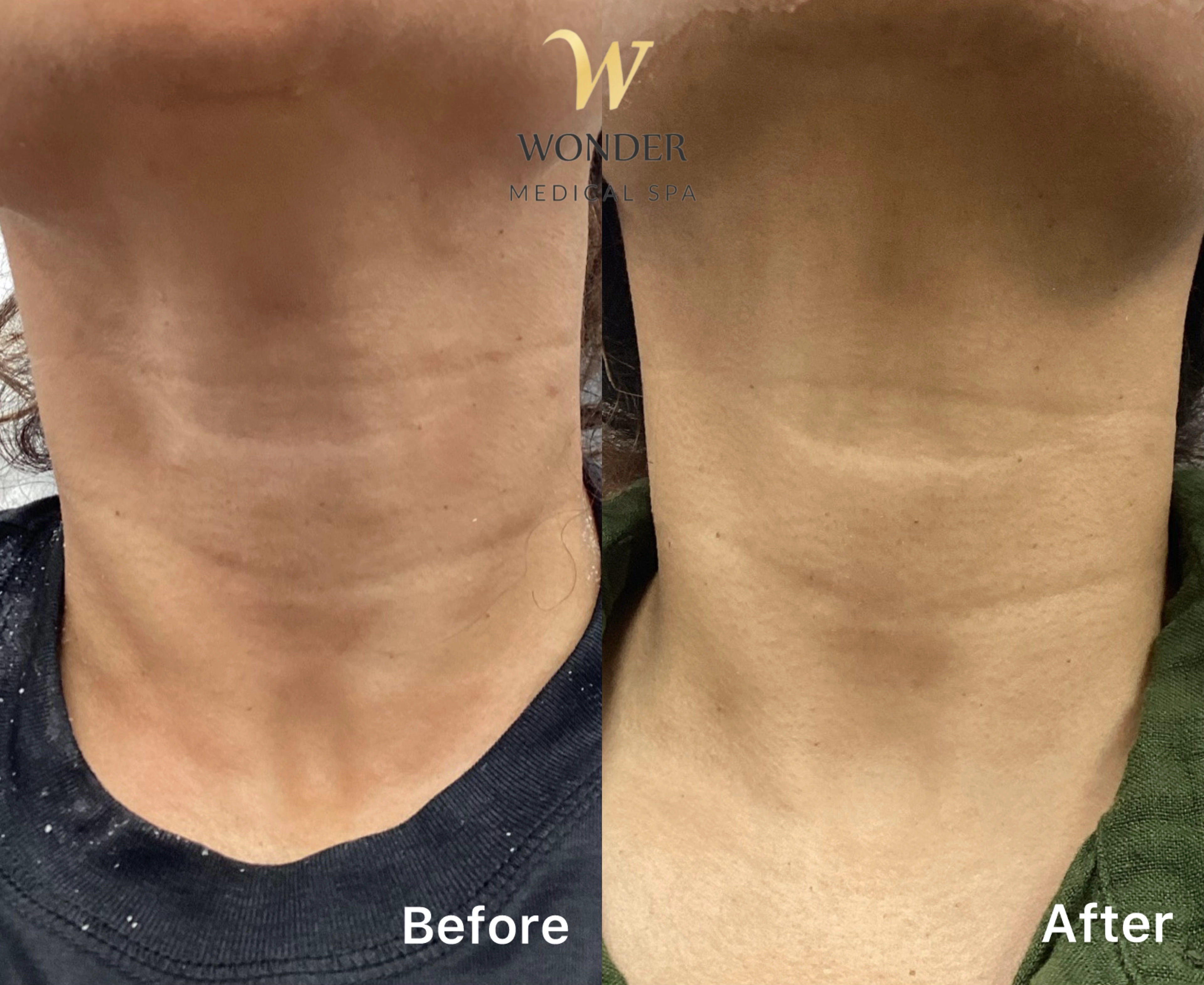 Sculptra Neck 4 Result