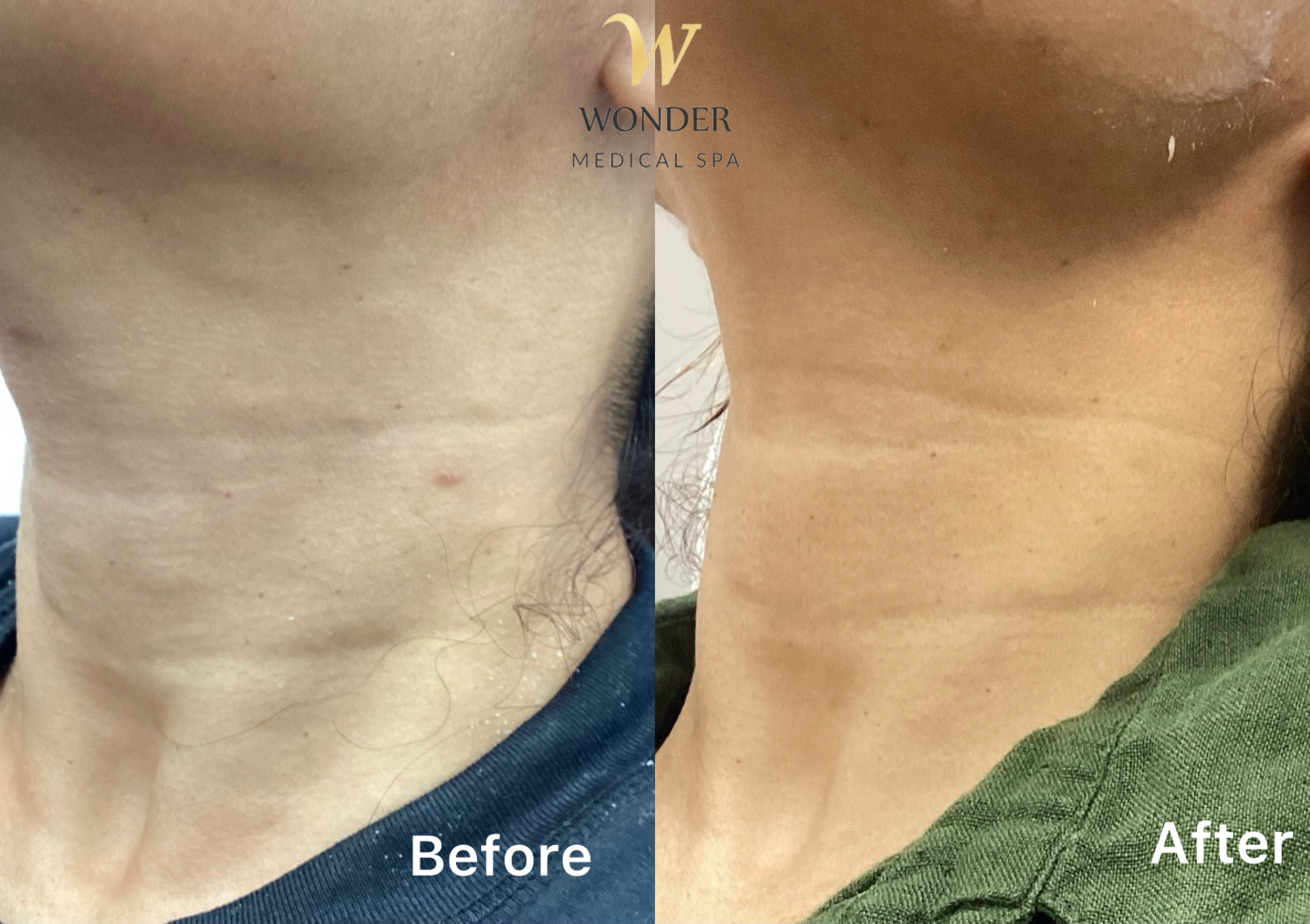 Sculptra Neck 5 Result