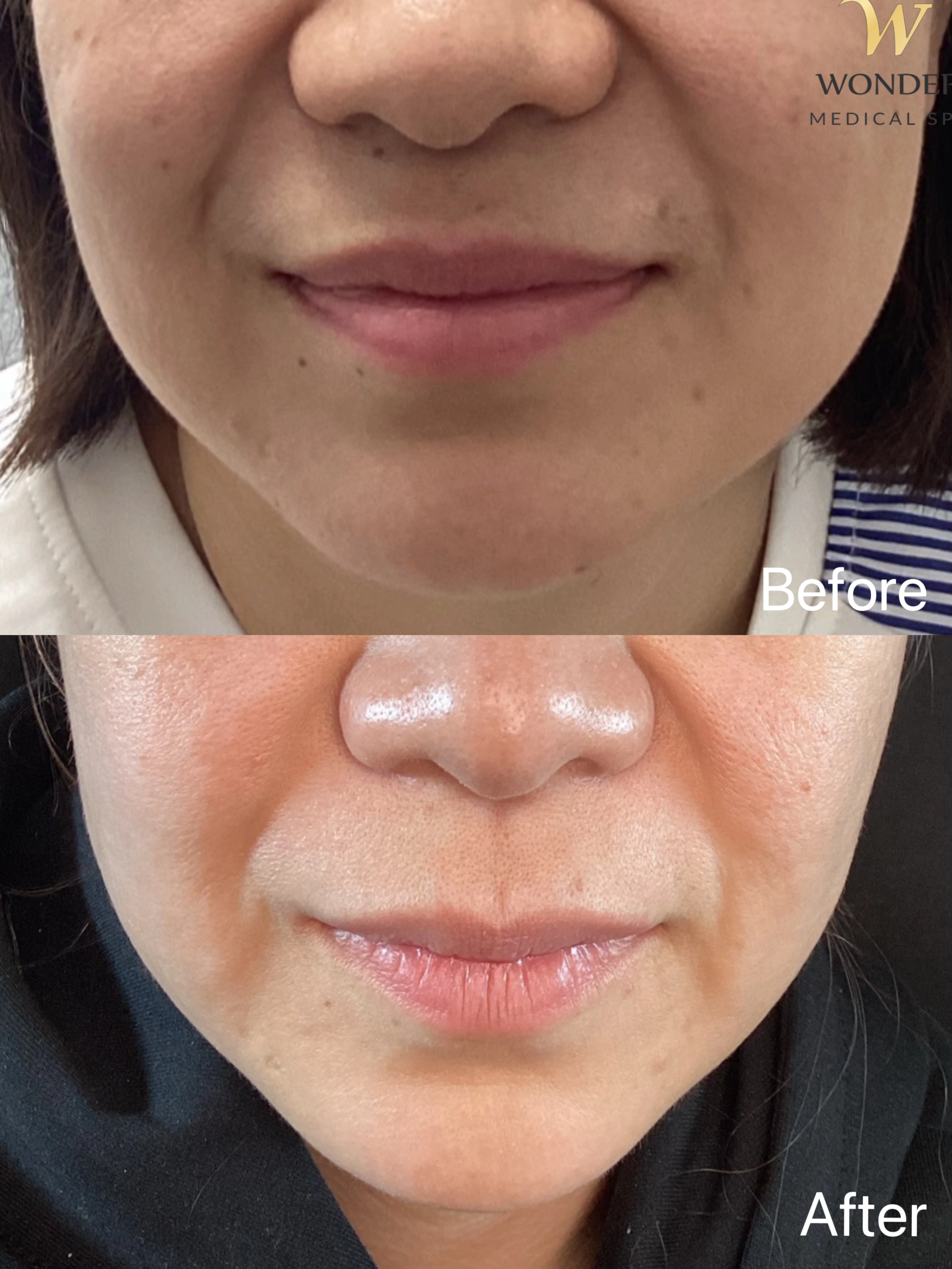 Ultherapy Result