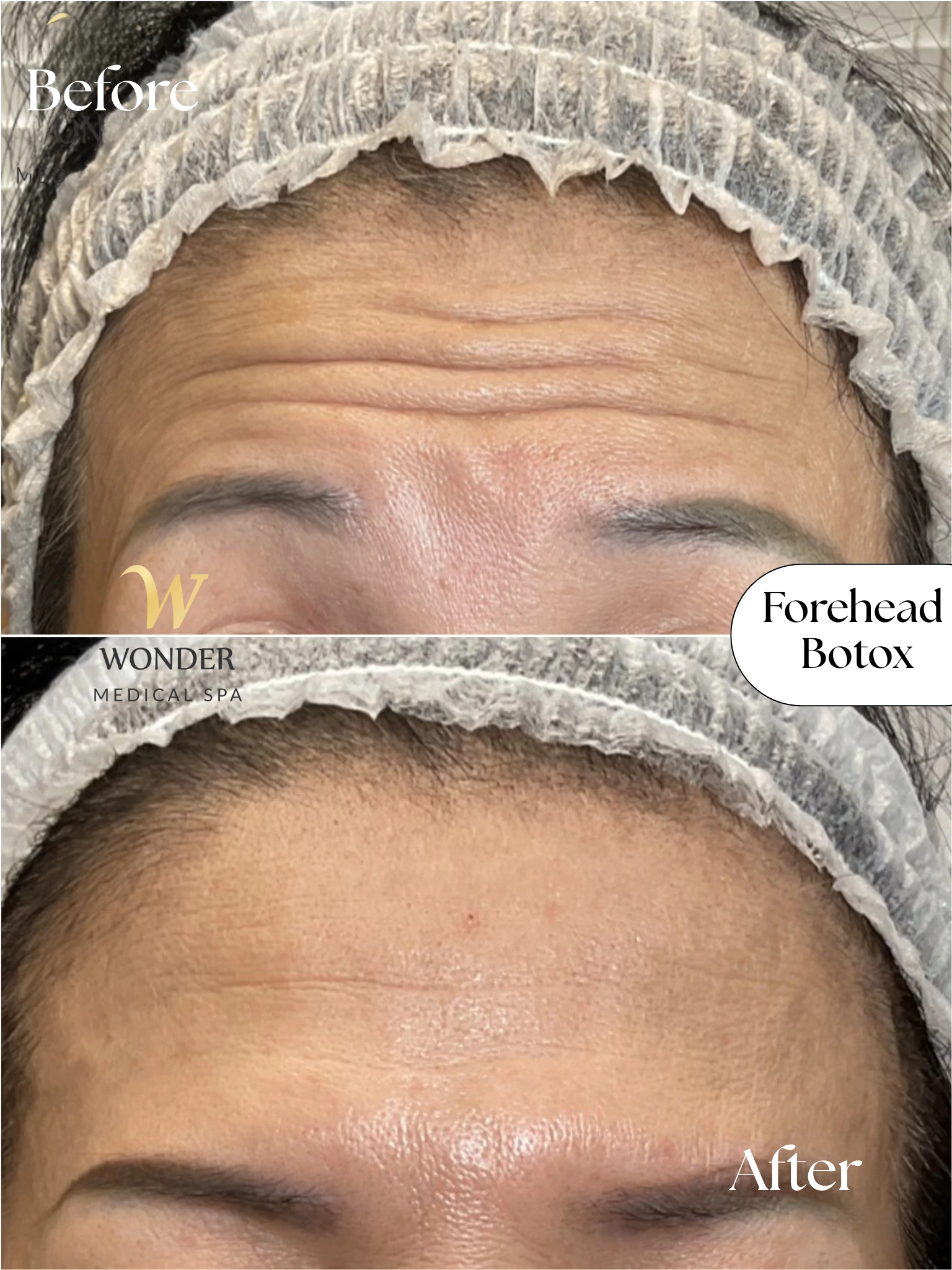Forehead Botox Result