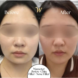 Masseter Botox+Chin Filler+Nose Filler Result