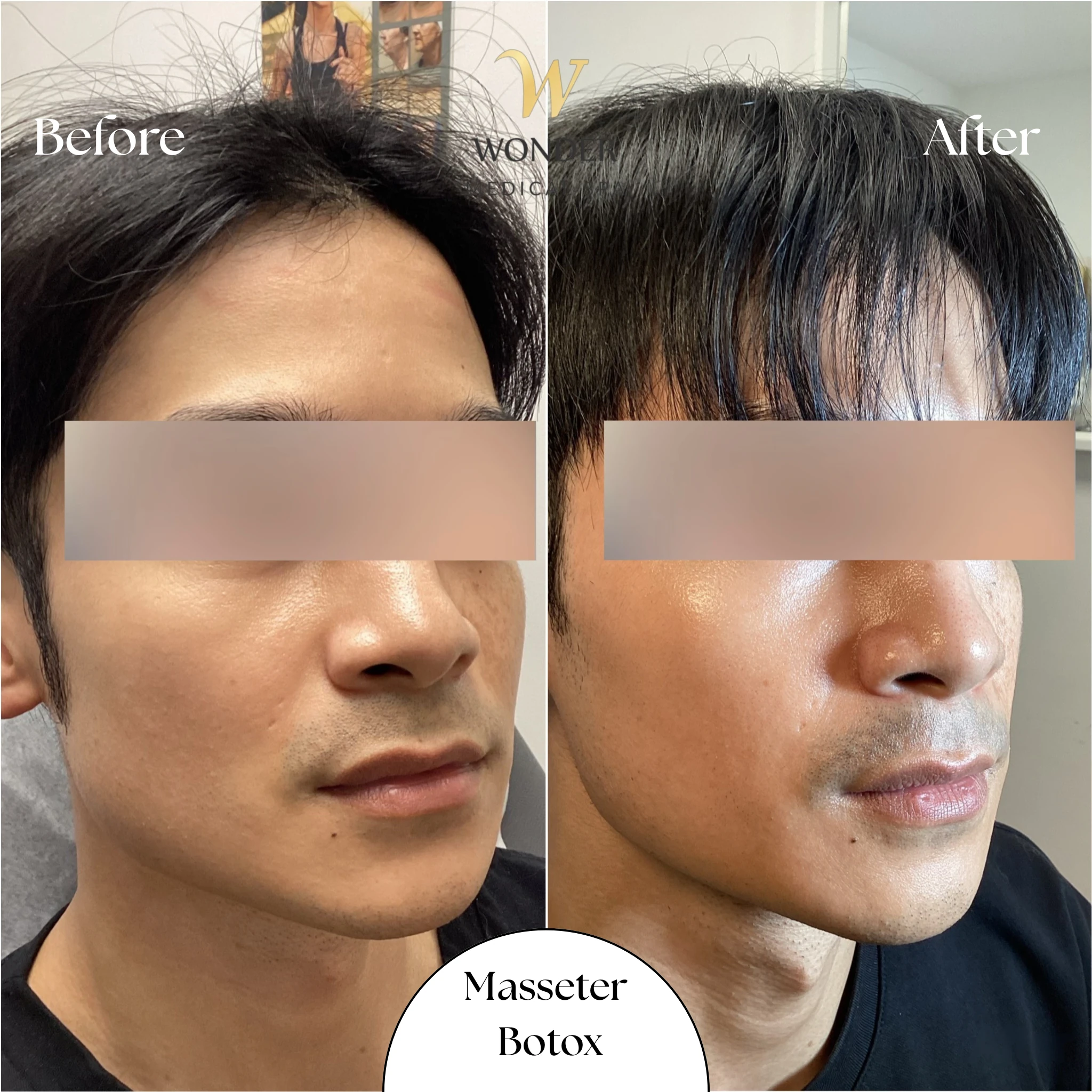 Masseter Botox Result