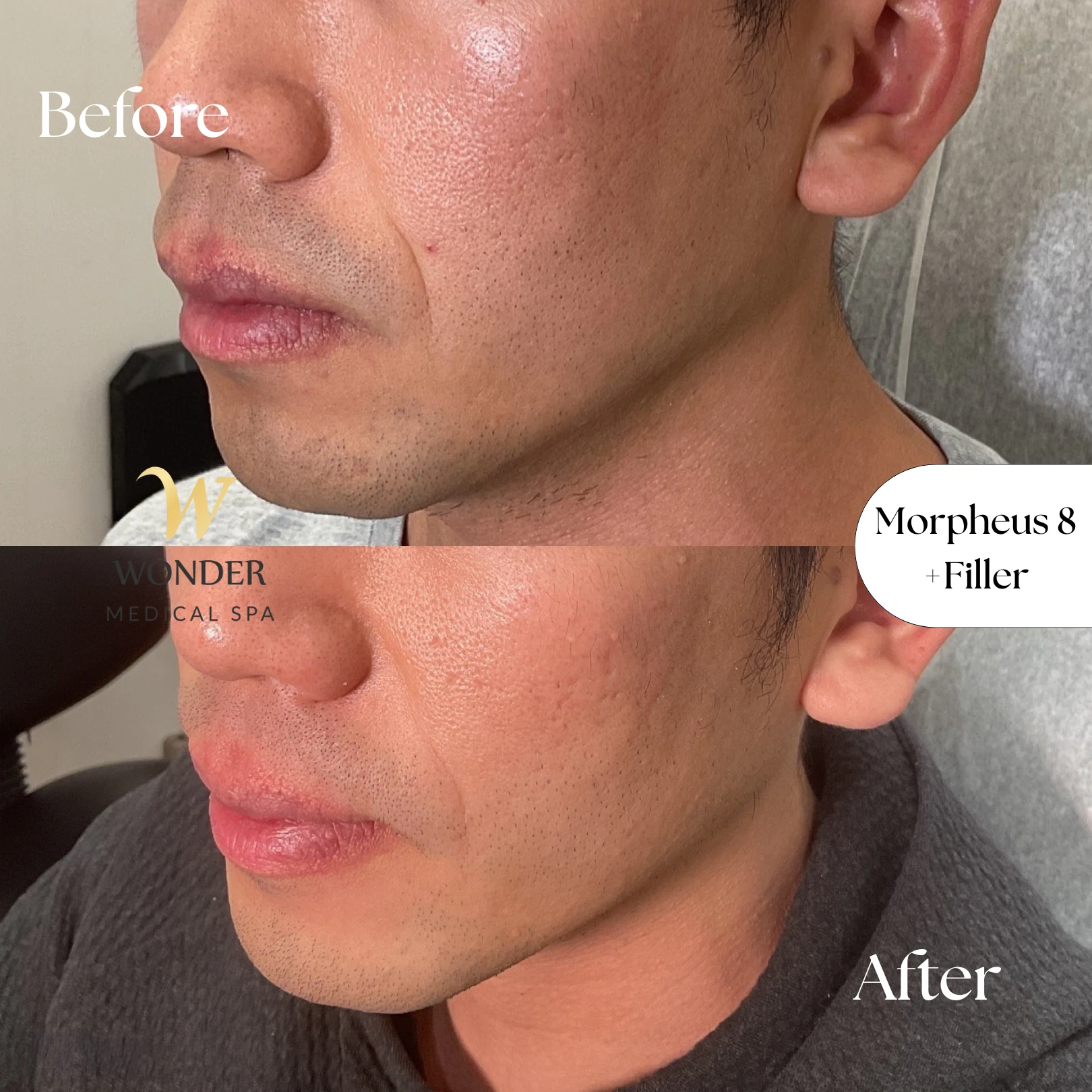 Morpheus 8 +Filler Result