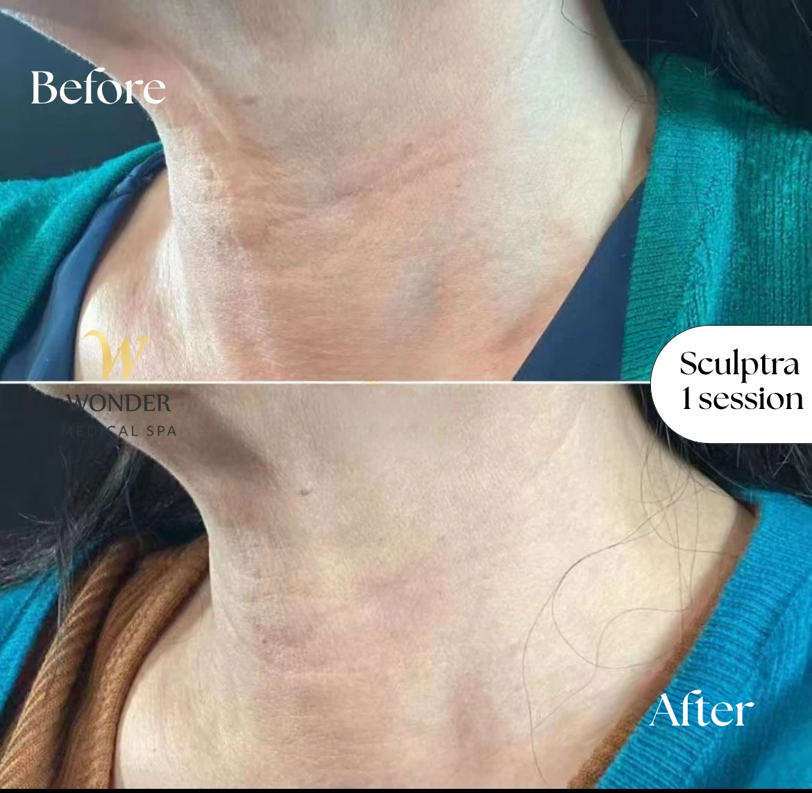 Sculptra 1 Session Result