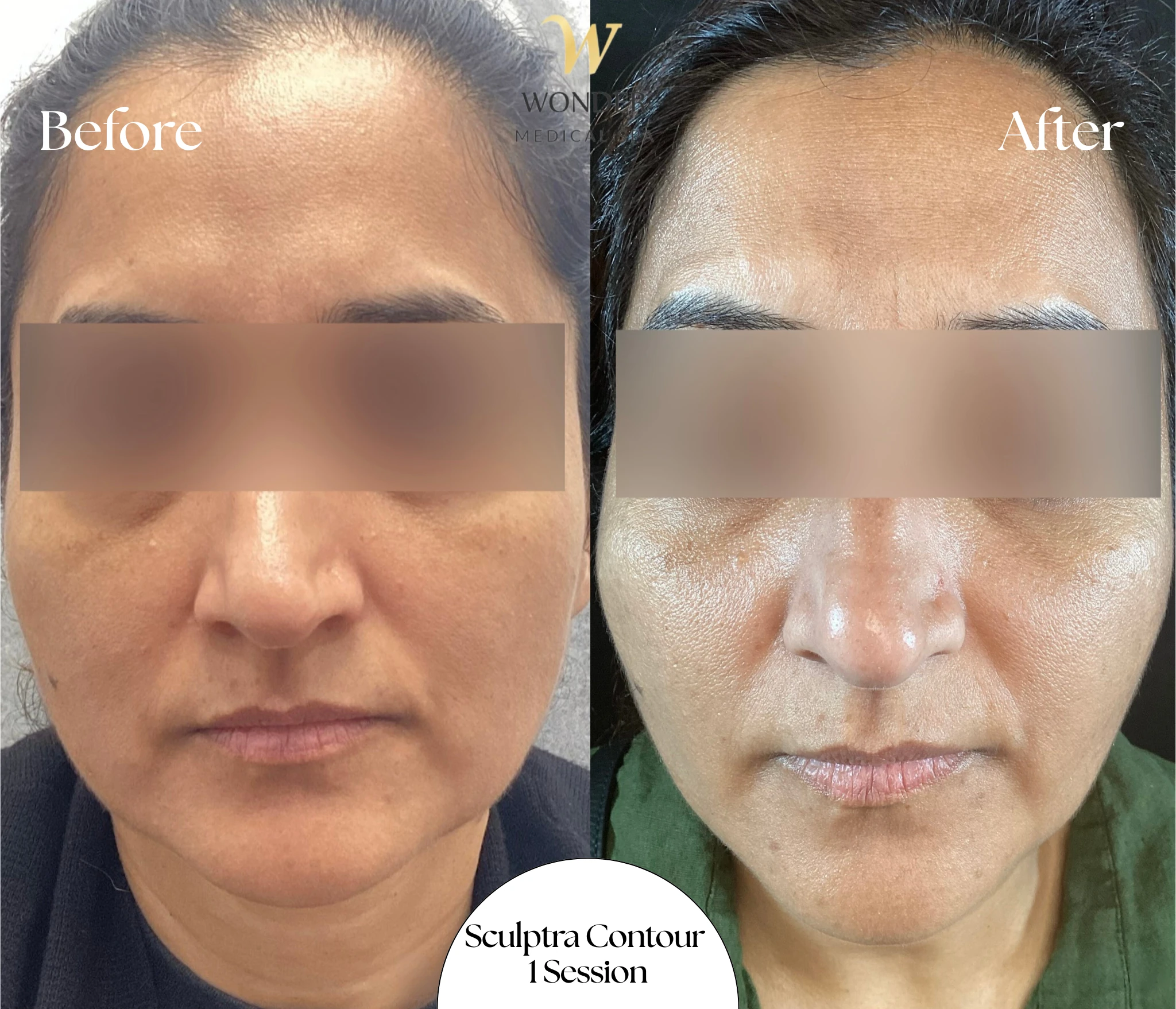 Sculptra Contour 1 Session Result