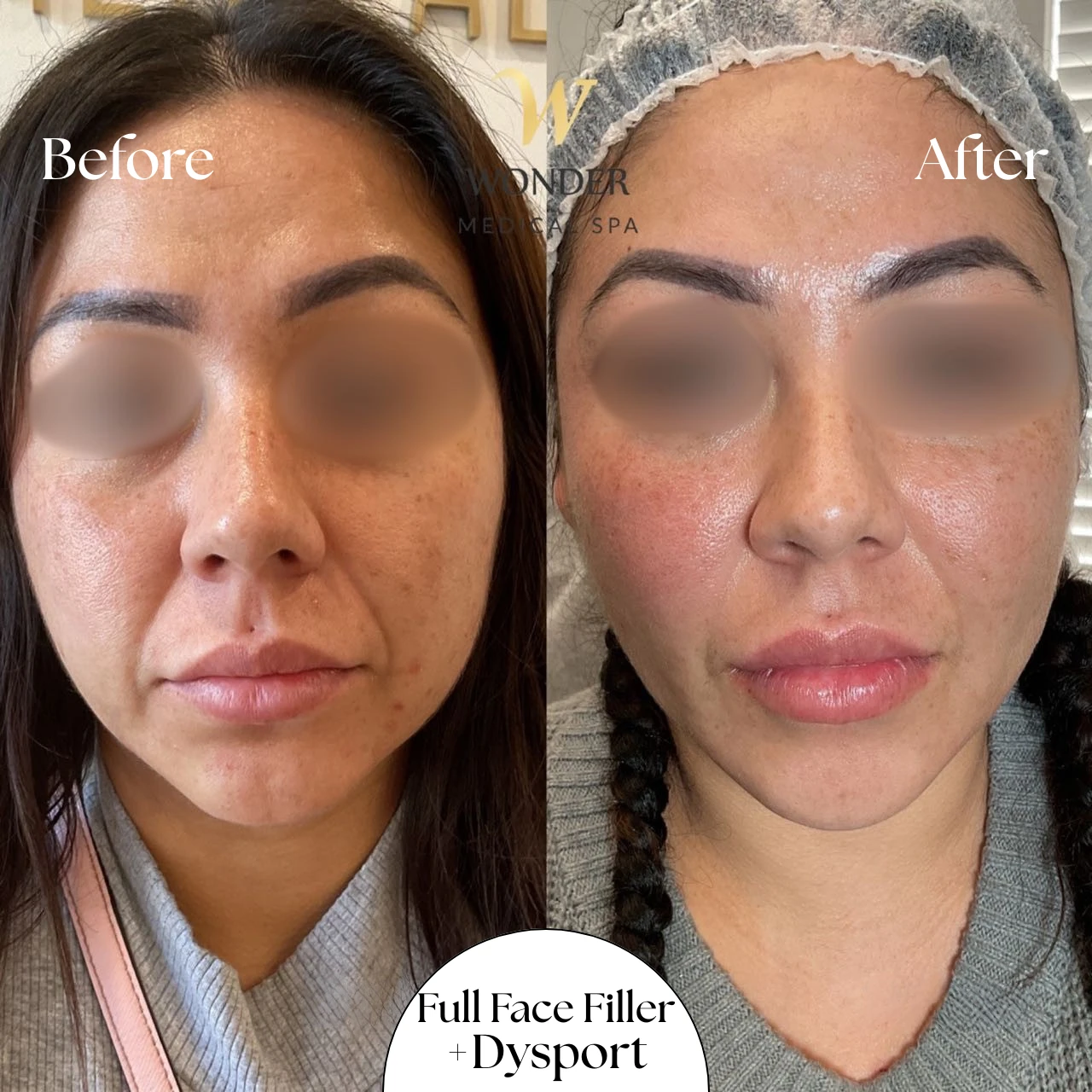 Full Face Filler+dysport Result