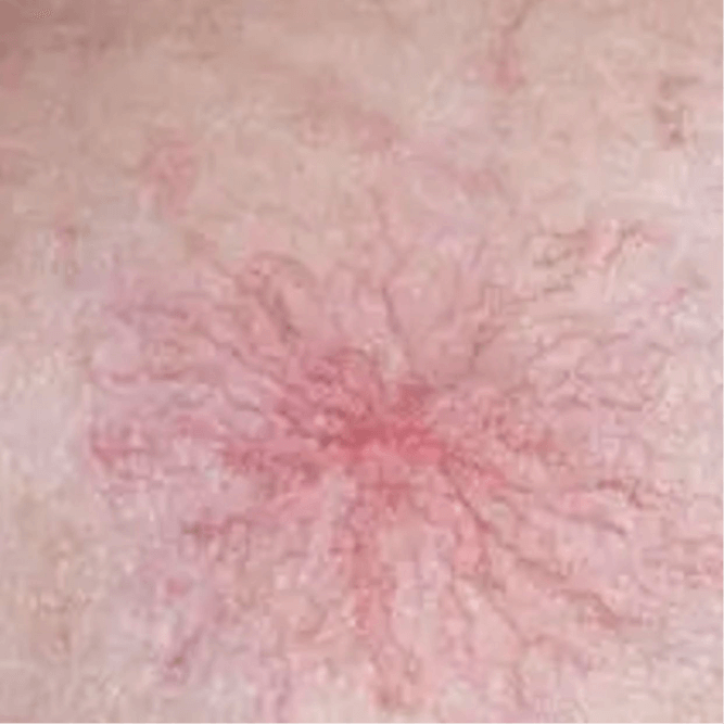 Cherry Angioma Removal