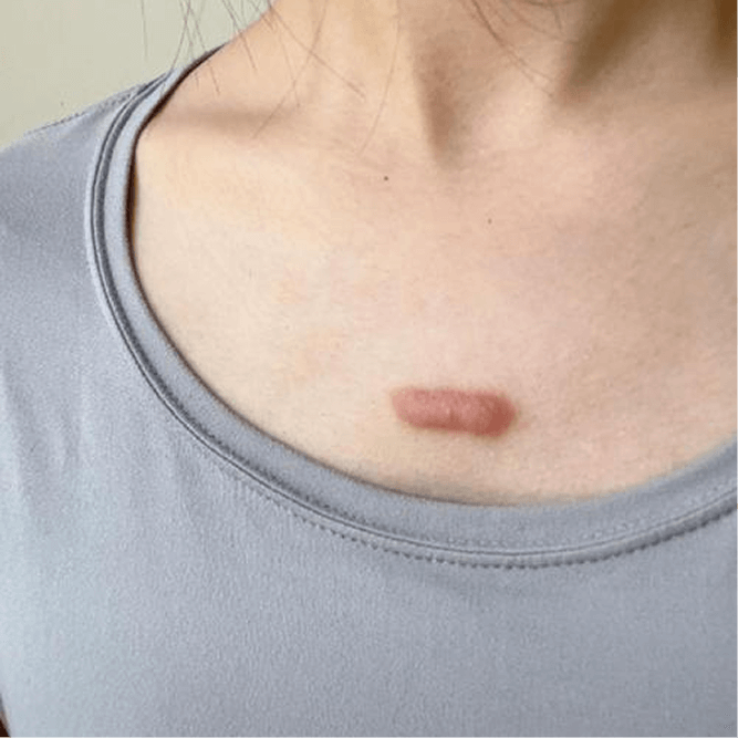 Keloid Scar Treatment