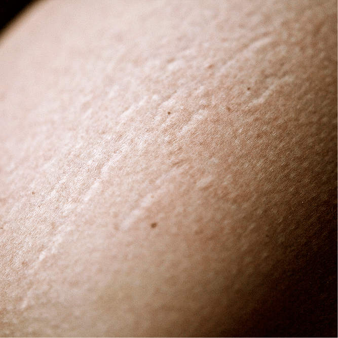 Stretch Mark Removal