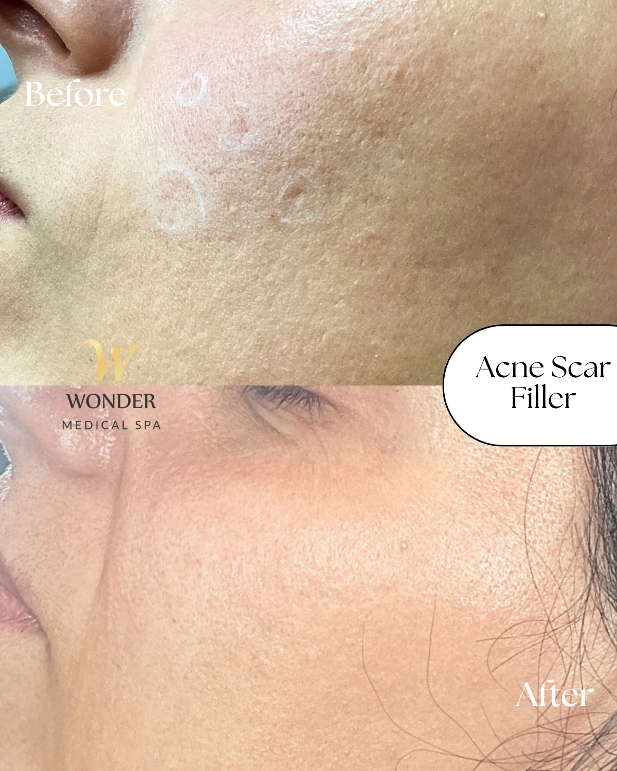 Acne Scar Filler
