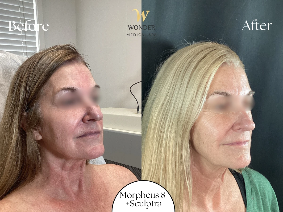 Morpheus 8  +Sculptra