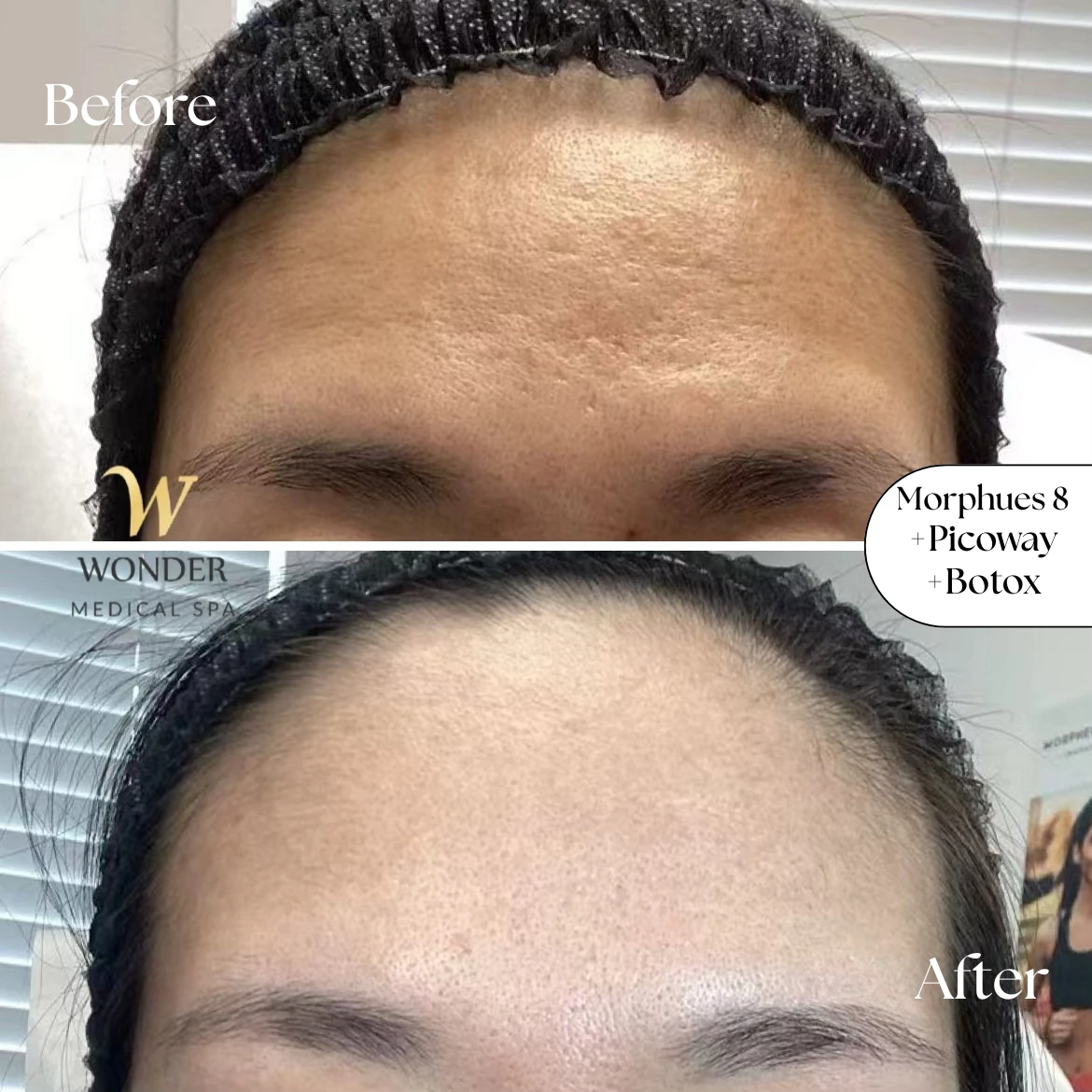 Morphues 8 +Picoway +Botox