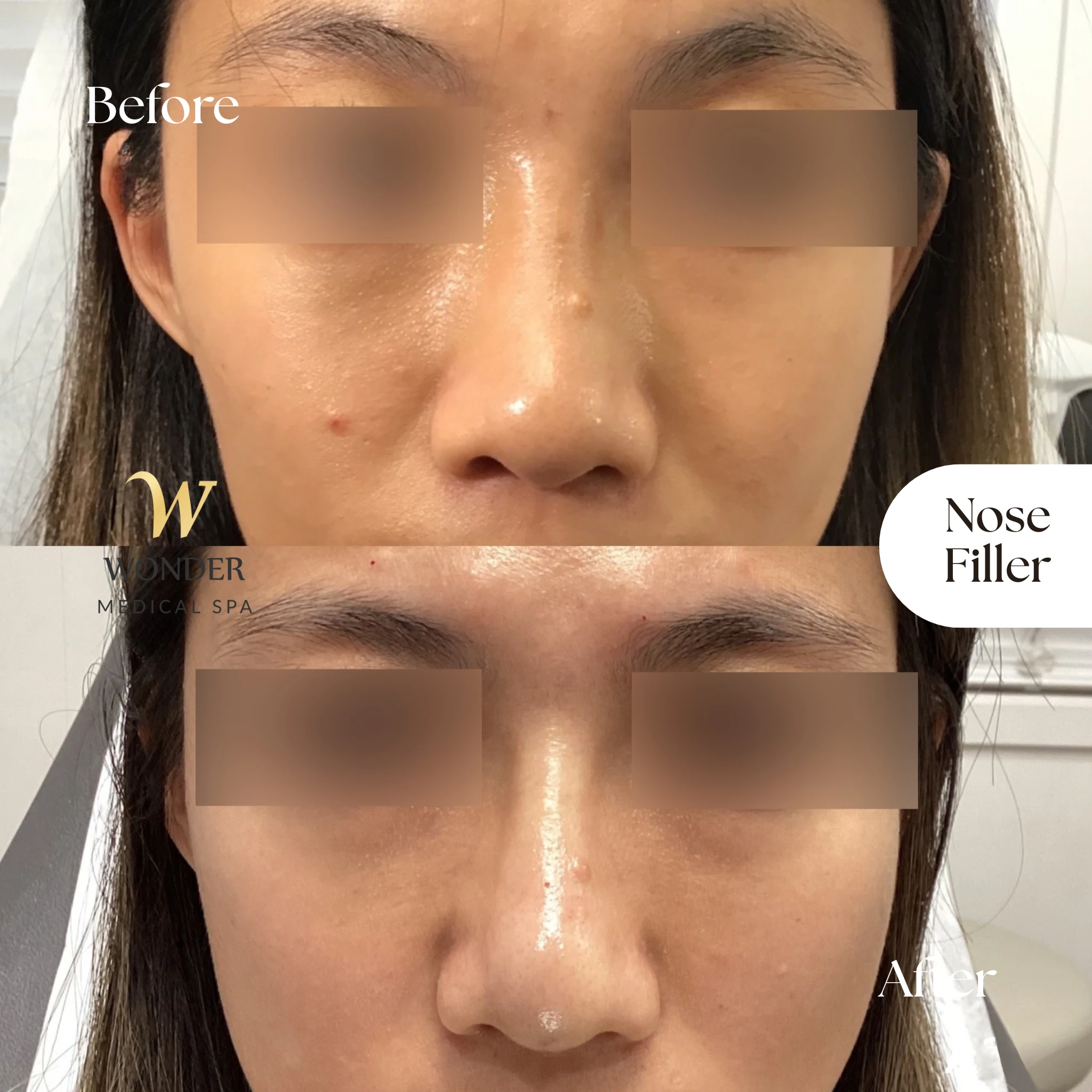 Nose Filler (2)
