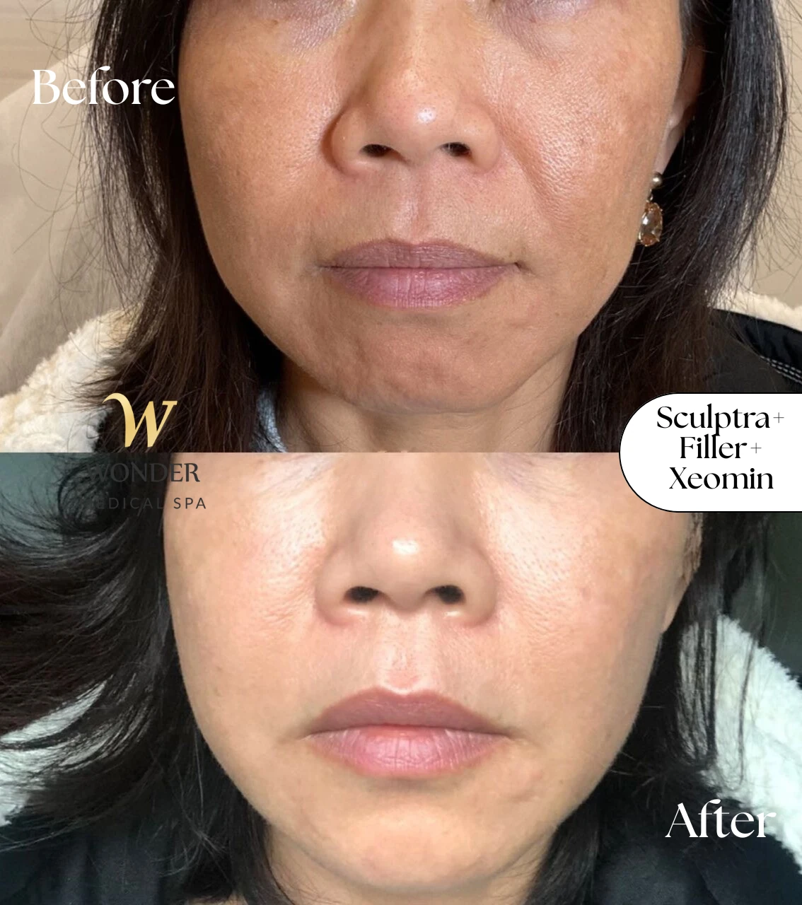 Sculptra+Filler+Xeomin