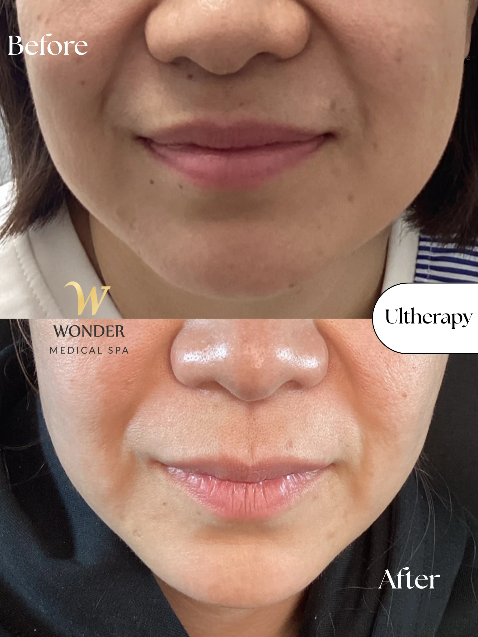 Ultherapy