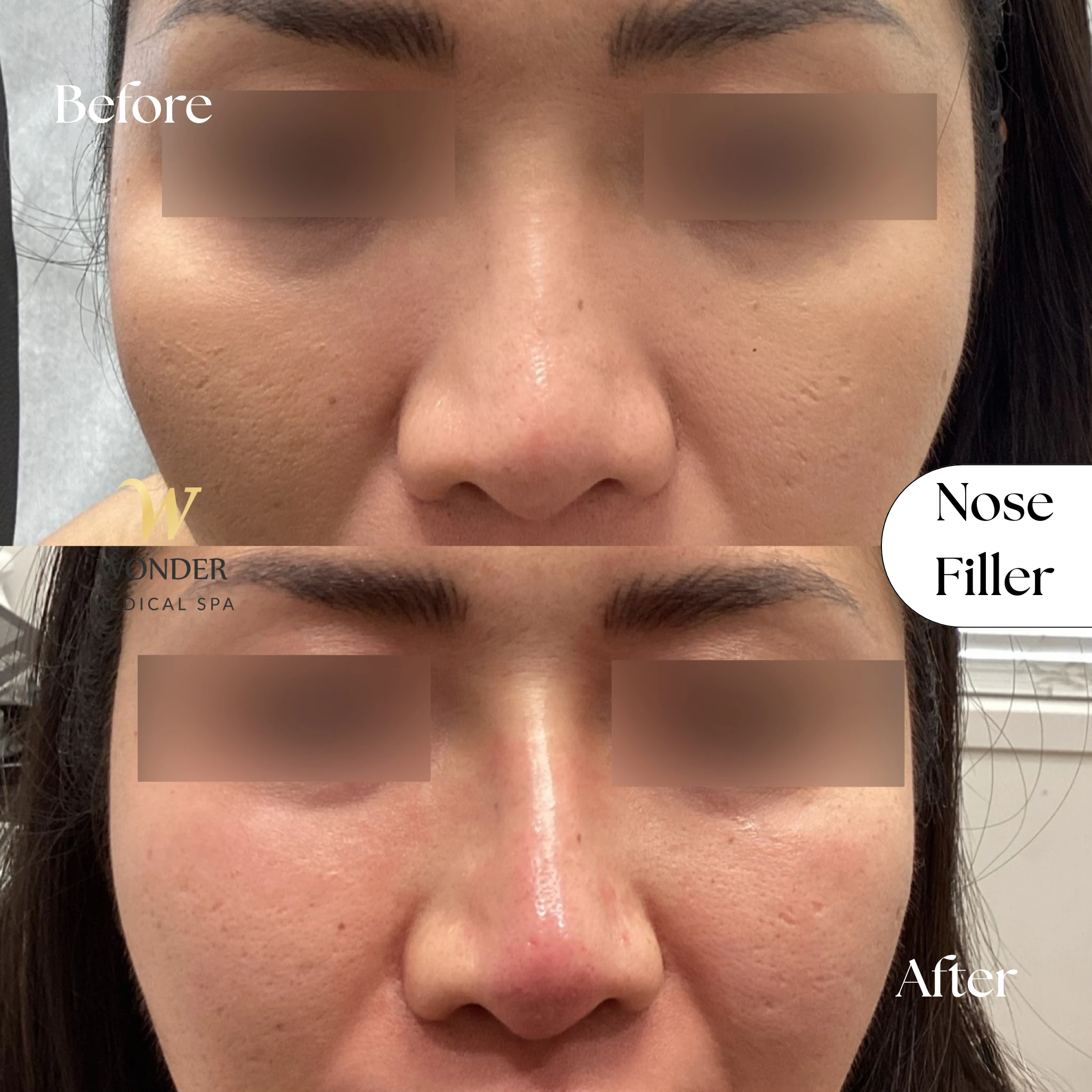 Nose Filler
