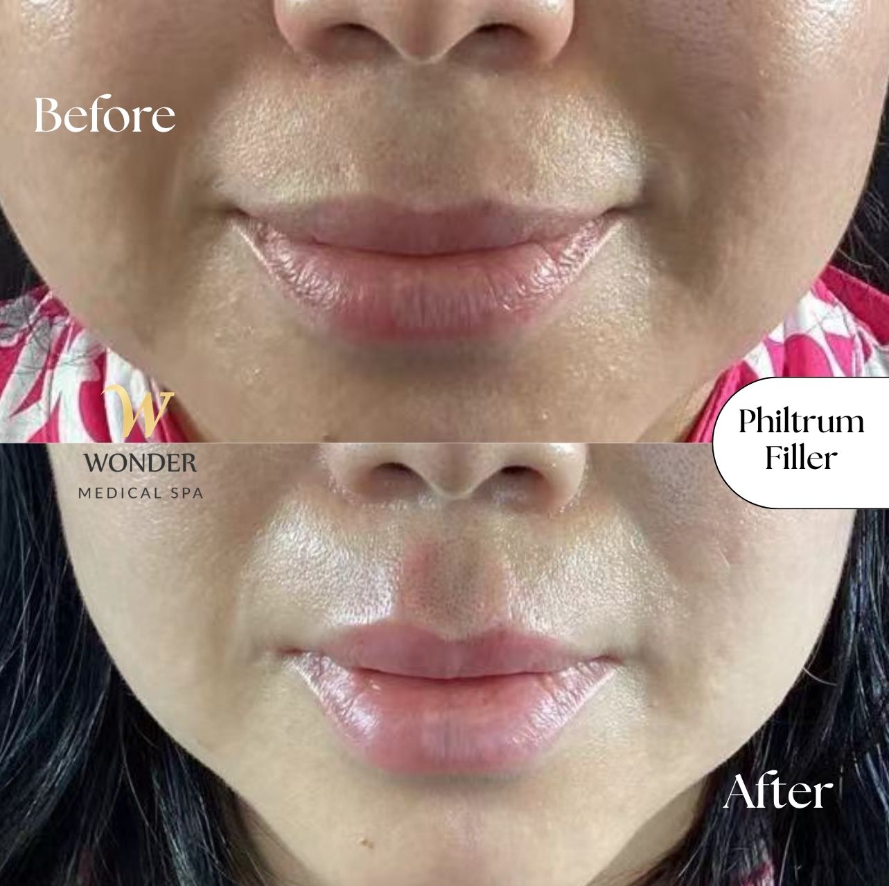 Philtrum filler